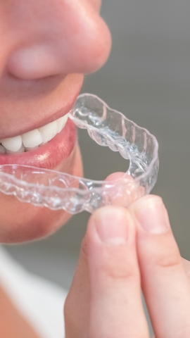 Invisible orthodondics